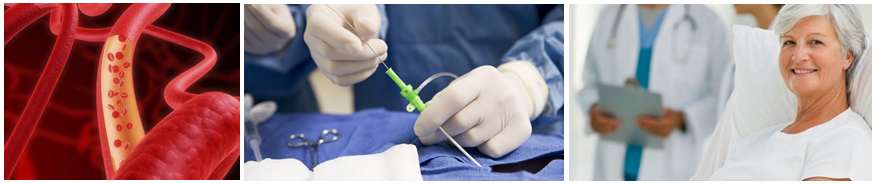 aneurysm_treatment_Viva-City
