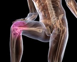osteoartrit_kolennogo_sustava