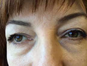 do operacii blefaroplastika