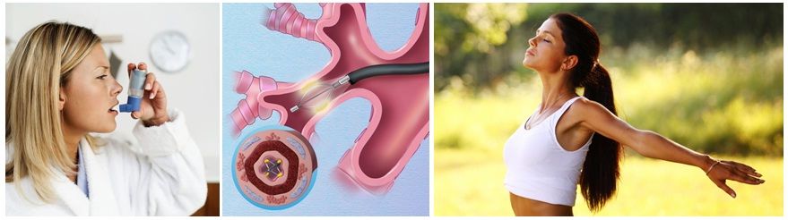 бронхиальная термопластика стоимость_bronchial thermoplasty_ Viva-City.jpg