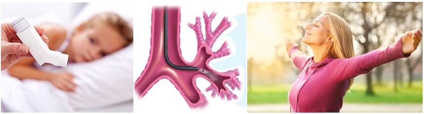 Бронхиальная термопластика в Сингапуре_ bronchial thermoplasty in Singapore_Viva-City Бронхиальная термопластика в Сингапуре_ bronchial thermoplasty in Singapore_Viva-City