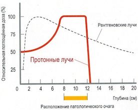 grafik_raspolozhenia_patologicheskogo_ochaga
