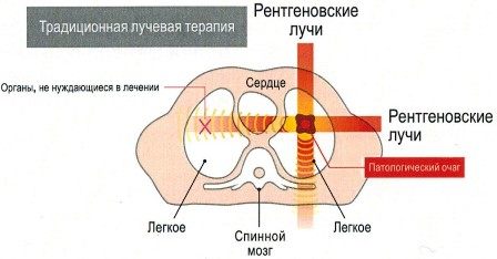 tradicionnaya_luchevaya_terapiya