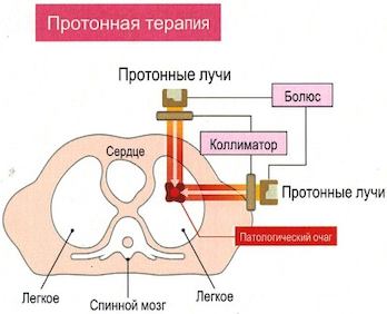 protonnaya_terapiya