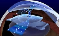 Факичные внутриглазные линзы, ICL, Implantable Collamer Lens, лечение в японии, офтольмология в японии, коррекция зрения в японии, астегматизм лечение, лечение миопии