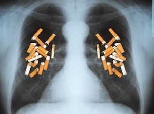 госпиталь Бумрунград интернешнл, Bumrungrad International Hospital, рак легких, рак легких лечение, рак легких симптомы, рак легких диагностика, рак легких причины, рак легких лечение в тайланде